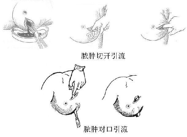 哺乳期乳腺炎不要急着切开引流