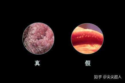 尖锐湿疣早期症状