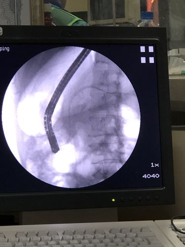 特殊患者请成都总医院张丙印主任来科行胰管支架
