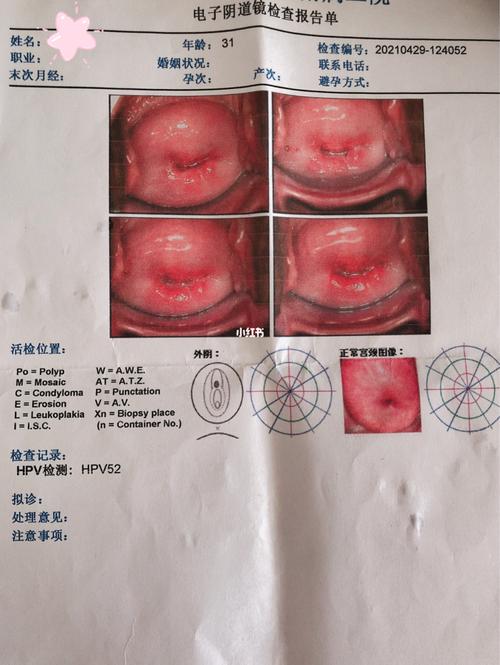 同房出血 宫颈癌筛查异常_宫颈癌_hpv_宫颈糜烂_二胎