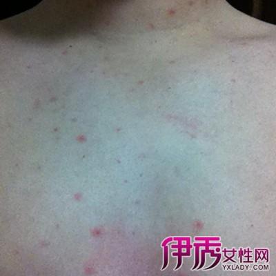 【图】展示艾滋病长小红点图片 6个常识可以有效预防艾滋病