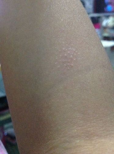 右胳膊上有两片这样的像鸡皮疙瘩一样的东西 很久了一直没下去 还有点