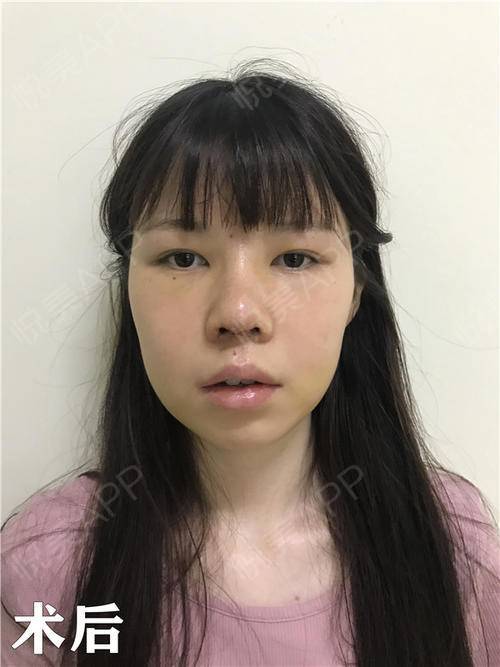 一招改变嘴凸面中凹陷