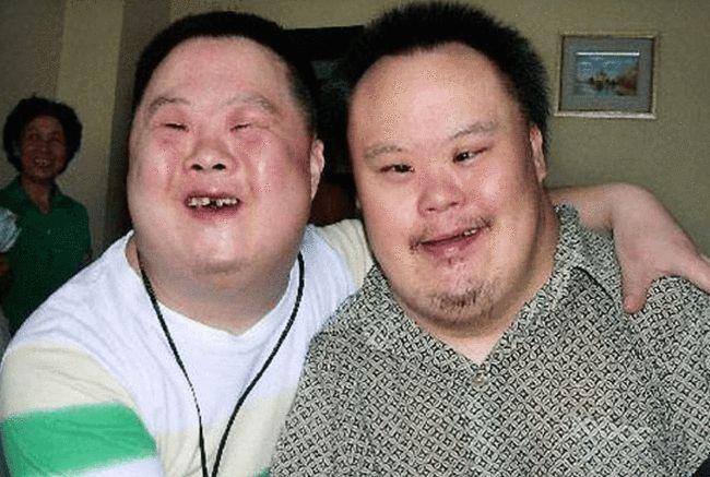 唐氏儿为啥都长得差不多?他们不遗传父母基因吗