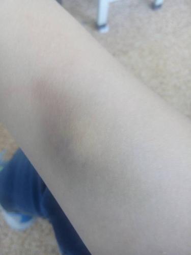 就是昨天发现胳膊上有淤青,倒是摸起来像蚊子盯的就是