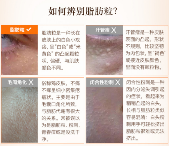 脂肪粒本尊它的实际上学名叫"粟丘疹",更常见于婴儿,很多婴儿出生后