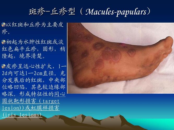 中西医结合课件 多形性红斑ppt