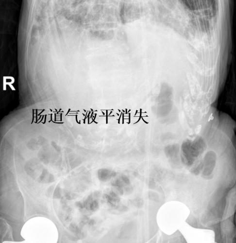 患者恢复了自主排气排便,复查x光片显示肠道的气液平完全消失,肠梗阻