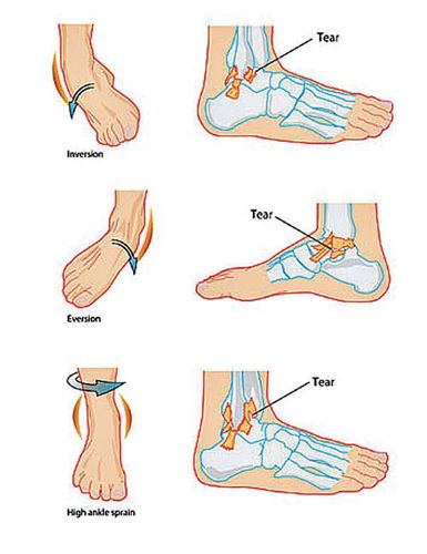 血液及体液会大量流出并充塞着整个脚踝关节,白血球活动会明显增加,并