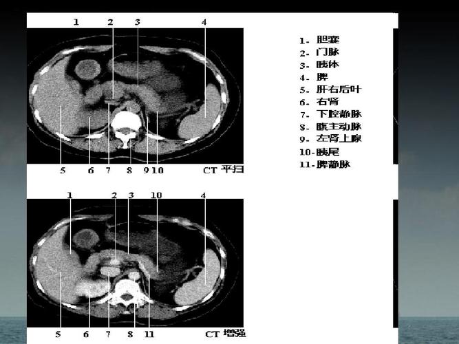 最新 急性胰腺炎ct分级ppt