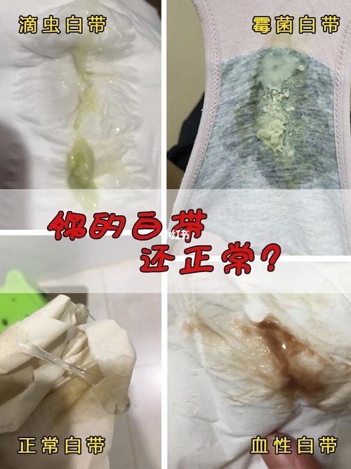 就越发的痒了,白带也是黏糊糊的_白带_内衣_滴虫性阴炎_医疗健康_医疗