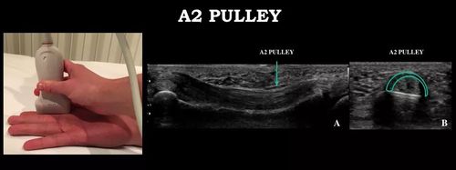 手指解剖和病理——us,mri对比