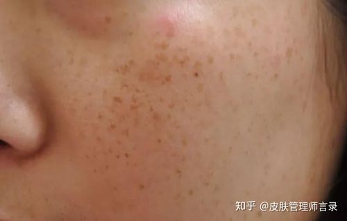 黄褐斑雀斑老年斑皮肤管理能解决么
