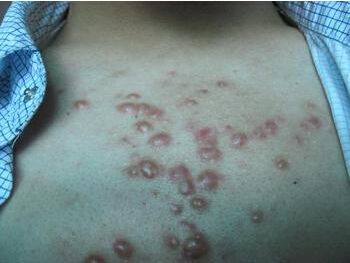 男性胸口长痘 胸口长了个硬疙瘩