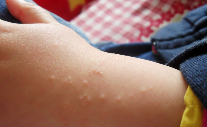 沙土性皮炎图片 (66)