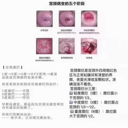 95科普:宫颈糜烂三度 女性反应表现为:出血,异味,瘙痒,同房后肚子痛