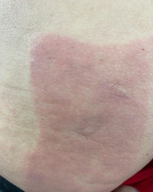 贴膏药过敏你知道这么治疗吗