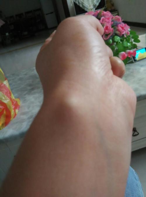 手腕上怎么会有个疙瘩只看楼主