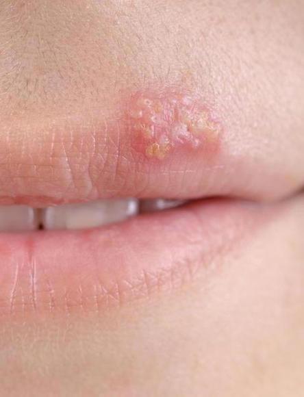 季嘴角生"疮"可能是疱疹