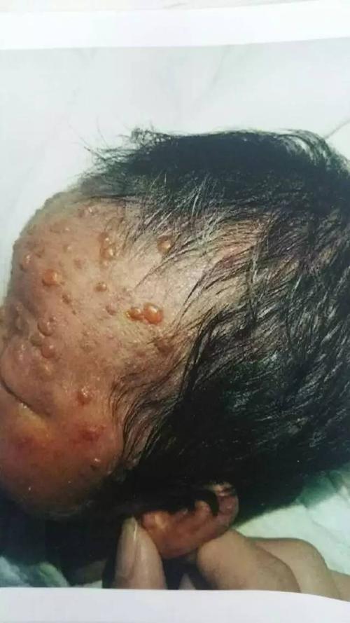 刚刚出生15天的小女孩,弱小的身体起满了脓疱疮(又名"传染性脓疱病"