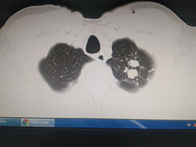 结核篇(肺结核:痰涂阳,多发区:锁骨区)