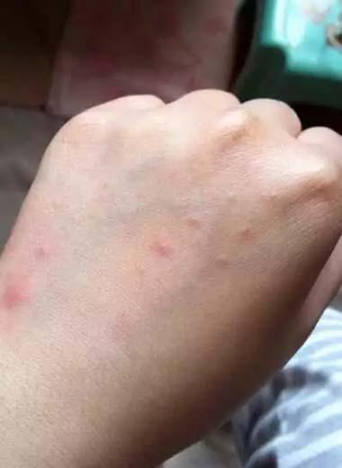 手部过敏,奇痒无比