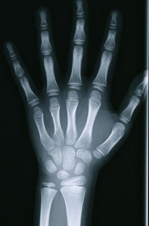 其实拍骨龄非常的简单,只需要带孩子去医院拍摄一次左侧腕关节正位x线