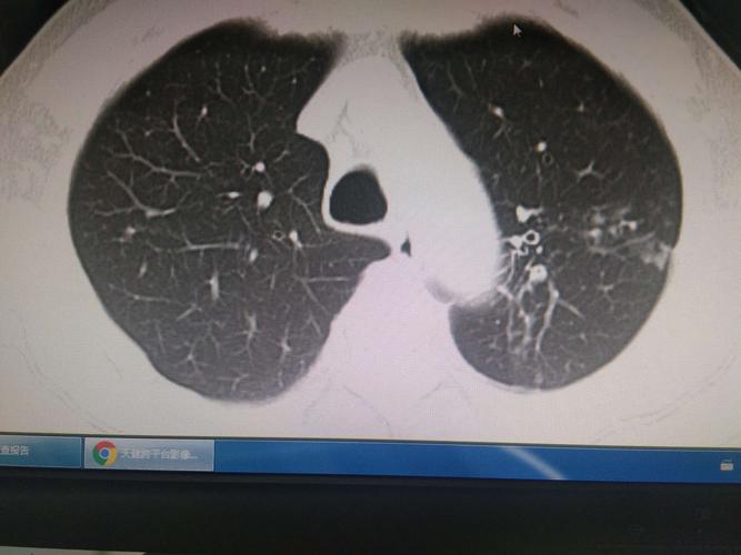 结核篇(肺结核:痰涂阳,多发区:锁骨区)