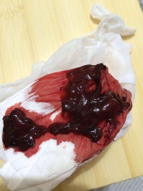 你好这种情况考虑,可以到医院去做个彩超看一下,有可能是子宫腺肌症的