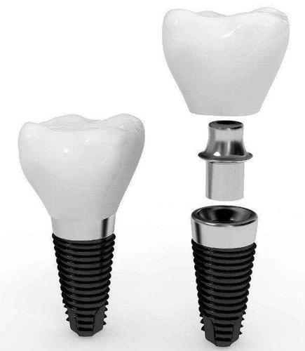 基台和种植体如何连接_口腔种植体有很多类型 你要慎重选择