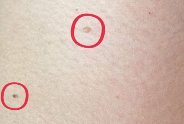 脖子上长小肉疙瘩,或是暗示5个问题,希望大家别大意了