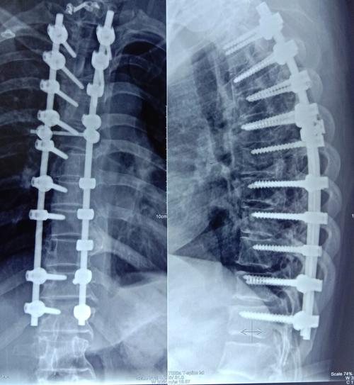 第二次术后,胸椎x线(胸2-11节段)