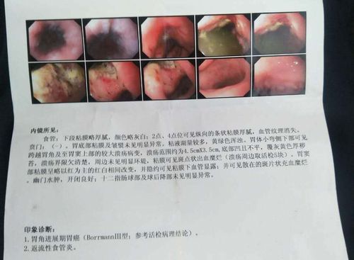 胃角低分化腺癌