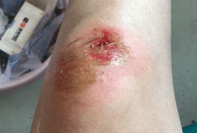 邵阳:俩美女教师摔伤,真是为孩子们操碎了心