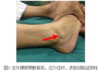 规范化诊治外踝韧带损伤