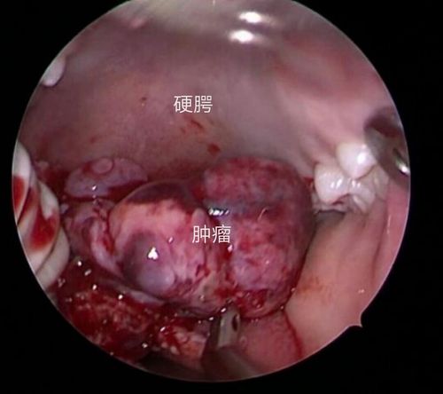 徐州市肿瘤医院耳鼻咽喉头颈外科新年开篇之作:经鼻