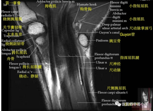 【高清mri图】腕关节磁共振mri解剖