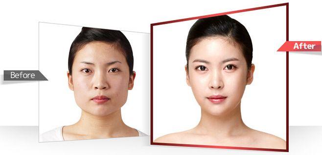 四方脸整形,韩国面部整形,韩国整形,韩国整形医院,韩国整容