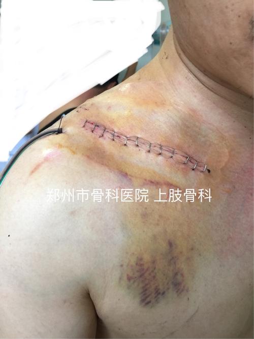 肩胛骨专用板治疗浮肩损伤病例分享