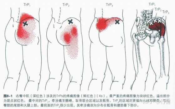腰椎间盘轻度突出但是臀部上方总是疼痛