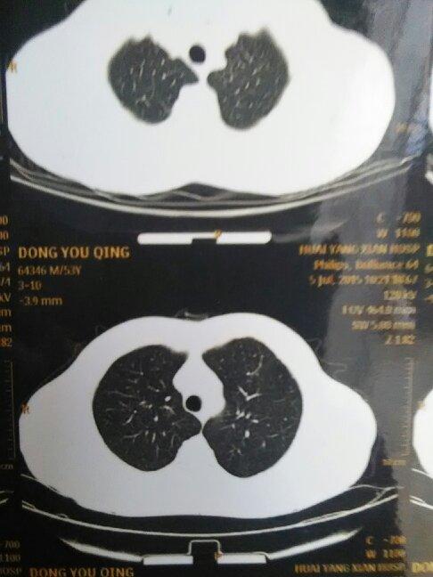 肺上有白点是怎么回事,去看了两次,拍的片子都一样,医生说只要不发展