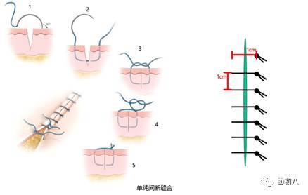 临行密密缝——不同缝合方法特点和适用条件(上)| 一页手册 · 协和八