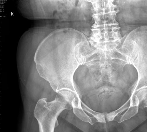 x9106耻骨联合病变