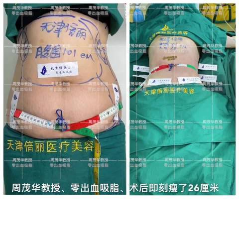 吸脂##腰腹吸脂##腰腹环吸