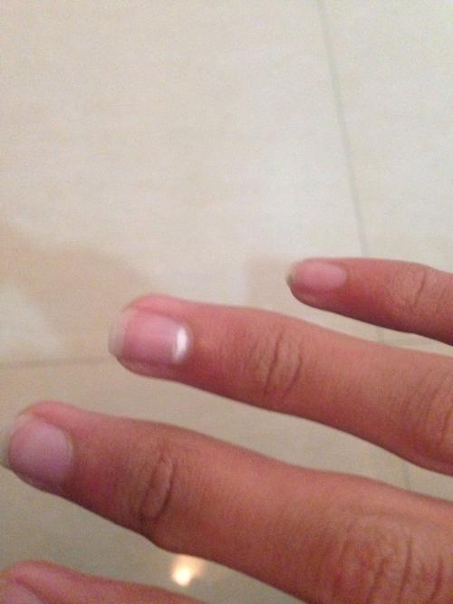 指甲里出现白块是怎么回事