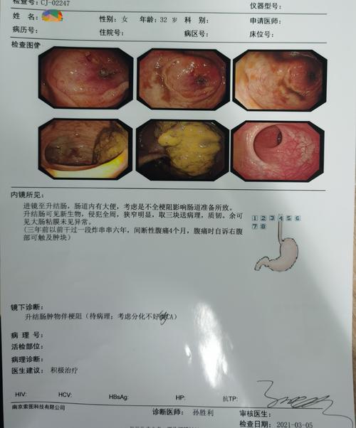 稳进慢退 围"单人肠镜并单人活检稳进慢退数袋操作法"