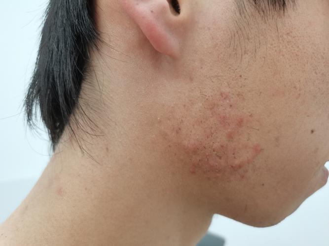 溯源,为什么长痘后会留下难看的瘢痕?