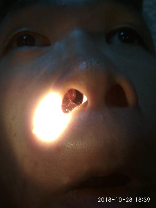 中药,每天一次自已放药,一个月后症状消失,这是一个七年鼻甲肿大患者