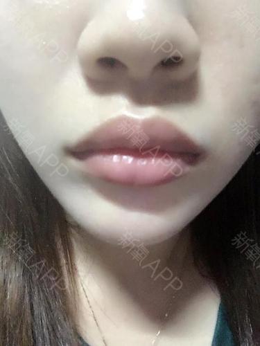 我想问我的这种唇型可以打嘟嘟唇嘛?打了以后会不会比现在更难看