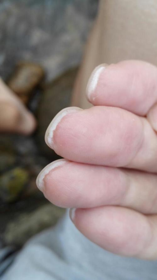 我手指甲夹那块 有突起一层的肉 平时剪指甲也不能见太短 因为指甲尖